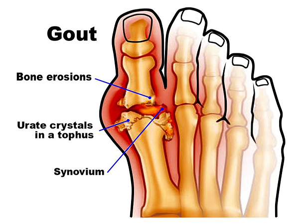 Điều trị gout